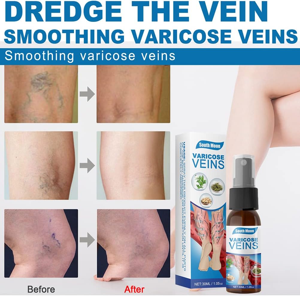 Varicose Veins Treatment Spray, Vein Healing Varicose Veins Treatment Spray, Varicose Veins Treatment for Legs, Varicose Veins Miracle Spray, Improve Blood Circulation